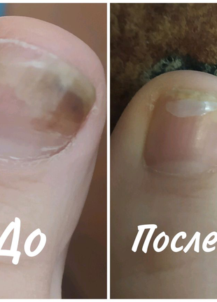 Курс лікування проти грибка нігтів юнайс терапія dermofuture