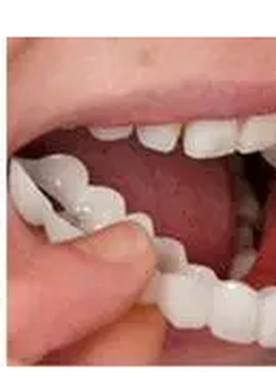 Вініри для зубів